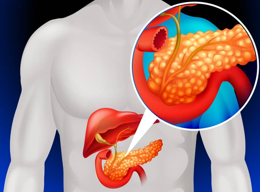 Nowa szczepionka usuwa ślady raka trzustki. Początek końca śmiertelnej diagnozy